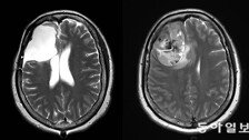 “갑자기 멍∼하고, 두통까지”… 건망증 아닌 뇌종양 신호일 수 있다[이진형의 뇌, 우리 속의 우주]