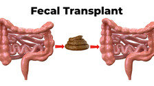 건강한 사람의 대변 이식, 암 치료의 ‘새 돌파구’ 될까