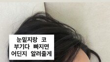 “부기 빠지면 병원 공개” 랄랄, 코 수술 후 자신감