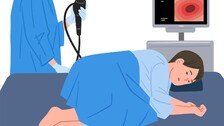 암환자 85% 5년이상 생존…“대장내시경 조기진단 효과 커”