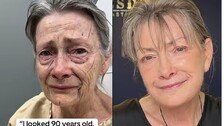 “30년 젊어졌다”…70세 여성, 안면거상 결과에 네티즌 감탄