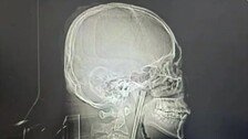 취중에 젓가락 꿀꺽, 목에 박혀…8년 지나서야 제거 수술
