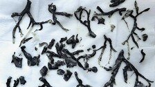 산불 연기 흡입한 美 80대 남성…폐에서 ‘검은 나무 모양’ 덩어리