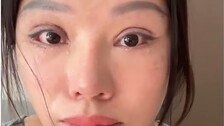 “눈이 안 감겨요”…무허가 쌍꺼풀 수술한 中여성 장애 판정