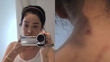 폐암 투병 이혜영 “곳곳에 수술 흉터…이겨내고 세상 나올 것”