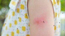 “서울서도 걸린다”…여름철 말라리아, 감기와 뭐가 다를까