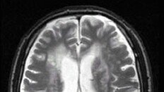 한국인 뇌구조-유전자 특성 파악… 전국민 조기진단 가능