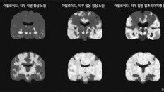 혈액-게놈-인공지능까지 활용… 치매 조기발견에 연구 사활