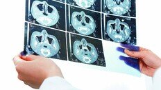 폐암 조기발견 땐 생존율 ‘쑥’… 구역 절제술로 기능 보존한다