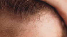 스테비아, 탈모인의 희망 되나? 미녹시딜과 ’찰떡궁합’