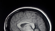 女, 치매 위험 두 배 높지만… 뇌 위축은 男이 더 심해