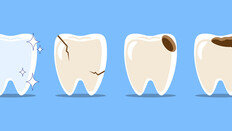 치아 법랑질, 한 번 닳으면 끝? “재생 기술 개발…내년 제품화 목표”
