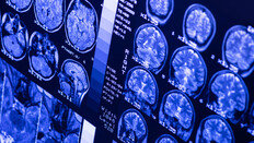 전문가들이 말하는 치매 위험 낮추는 ‘5가지 전략’