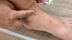 “비행기서 빈대 나와 여행 망쳐” 3억 원대 소송