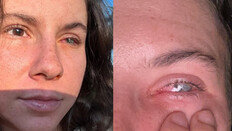 “눈 비볐을 뿐인데 기생충 감염” 20대女 실명 충격