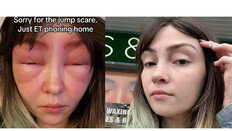 “눈썹 염색하다 ‘외계인’ 됐다”…알레르기 테스트의 중요성