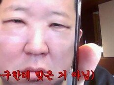 정형돈 “눈밑지방 재배치 강추”…수술 직후 붓기 사진까지 공개