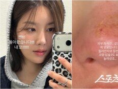 권은비, 킬리만자로 등반 후 코·입술 2도 화상…“내 코 돌아왔다”