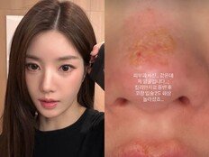 권은비, 코·입술 2도 화상 충격 “제 얼굴…놀라셨죠”