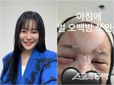 랄랄, 눈밑지방 재배치+코 수술…“벌 500방 맞은 느낌” 고백