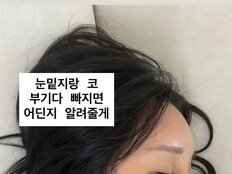 랄랄, 눈밑지·코 수술 후 인증샷…‘오똑한 코’ 눈길