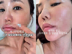 43세 강예빈 근황, 피부 다 뒤집어지고 난리나 ‘무슨 일’