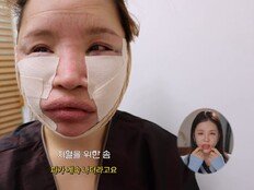 라뮤끄, 얼굴 지방 흡입 극심한 고통 “주변 다 말려, 과거 돌아간다면…”