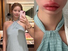 맹승지, 입술 필러 제거 후 퉁퉁…“과유불급 깨달아”