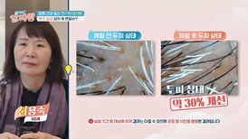 『두피 개선 프로젝트』 맥주 효모 섭취 후 상태 변화는?! | JTBC 240328 방송