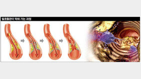 걷기 힘든 통증 혈관질환부터 의심해야