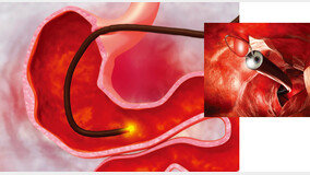 한때 세계 1위였던 위암, ‘이 검사’ 덕분에 줄었습니다 