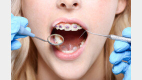 통증 적고 치아 위생 관리에 유리한 ‘투명 교정 장치’