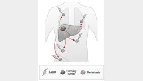 간암 부위에 고선량 방사선 쏴 치료… “효과-안전성 높아”