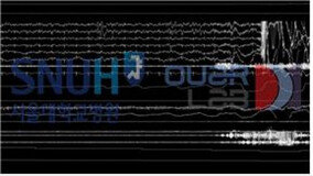 서울대병원, 이미지 기반 수면 단계 자동판독 알고리즘 개발