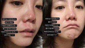 Go Eun-ah, sad recent situation after facial injury… “I‘m afraid it’ll leave a scar” [DA★]