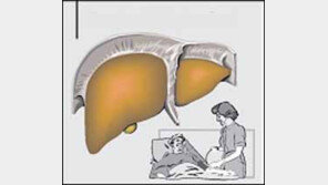 [아하! 질병이야기]간경변…당신의 肝 쪼그라든다