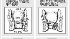 [일반건강]치질,  초기 치료가 중요