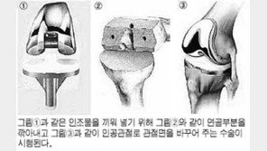 [건강 100세 ABC]관절염 치료와 수술후 관리법