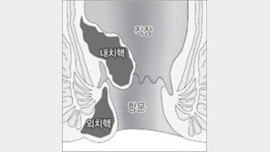 [장이 튼튼해야 생활이 즐겁다]<3>‘부끄러운’ 항문질환