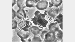 [동아e메일 클리닉]패혈증, 어떻게 걸리는지…