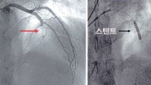 [의사 선생님 내 심장이…]<2>급성심근경색