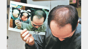 [헬스&뷰티]탈모 세대교체… 젊은층-여성환자 급증