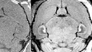 0.7mm 뇌속 암세포도 찾아낸다…“치매-간질도 진단”