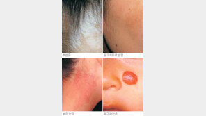 아이 얼굴에 반점… 방치 땐 마음에 반점