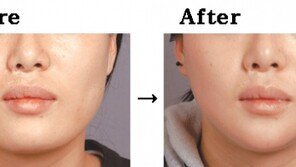 [헬스&뷰티]U → V라인 갸름한 턱으로 윤곽성형 세계최고 수준