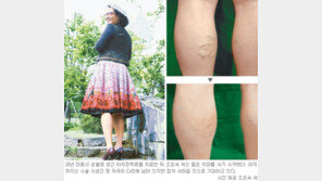 [헬스&뷰티/Before & After]하지 정맥류