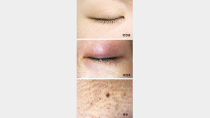 [헬스&뷰티]어머 징그러워, 눈가 목 가슴에 올록볼록