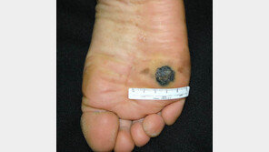 복점? 치명적인 종양일 수도