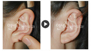 귀걸이에 걸려 찢어진 귀, 인상 망친다