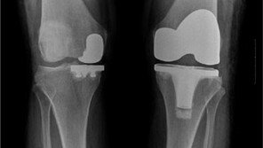 퇴행성관절염, 자기관절 보존하는 부분 치환술로 해결!